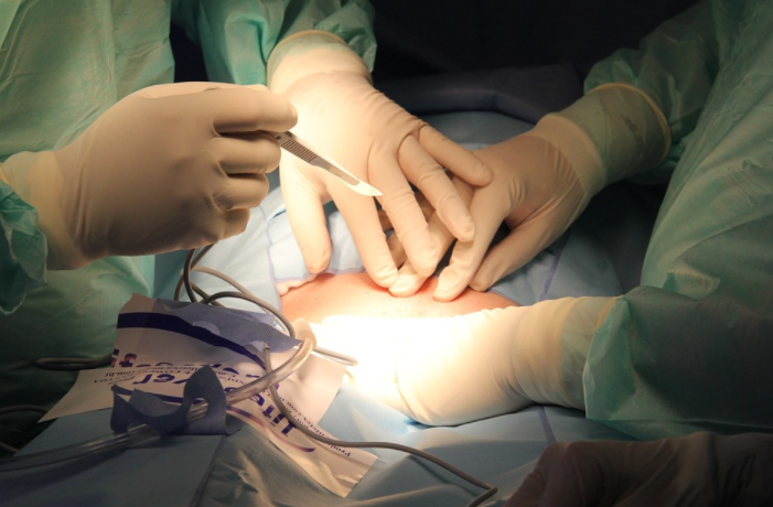 Excellent Benefits of Liposuction